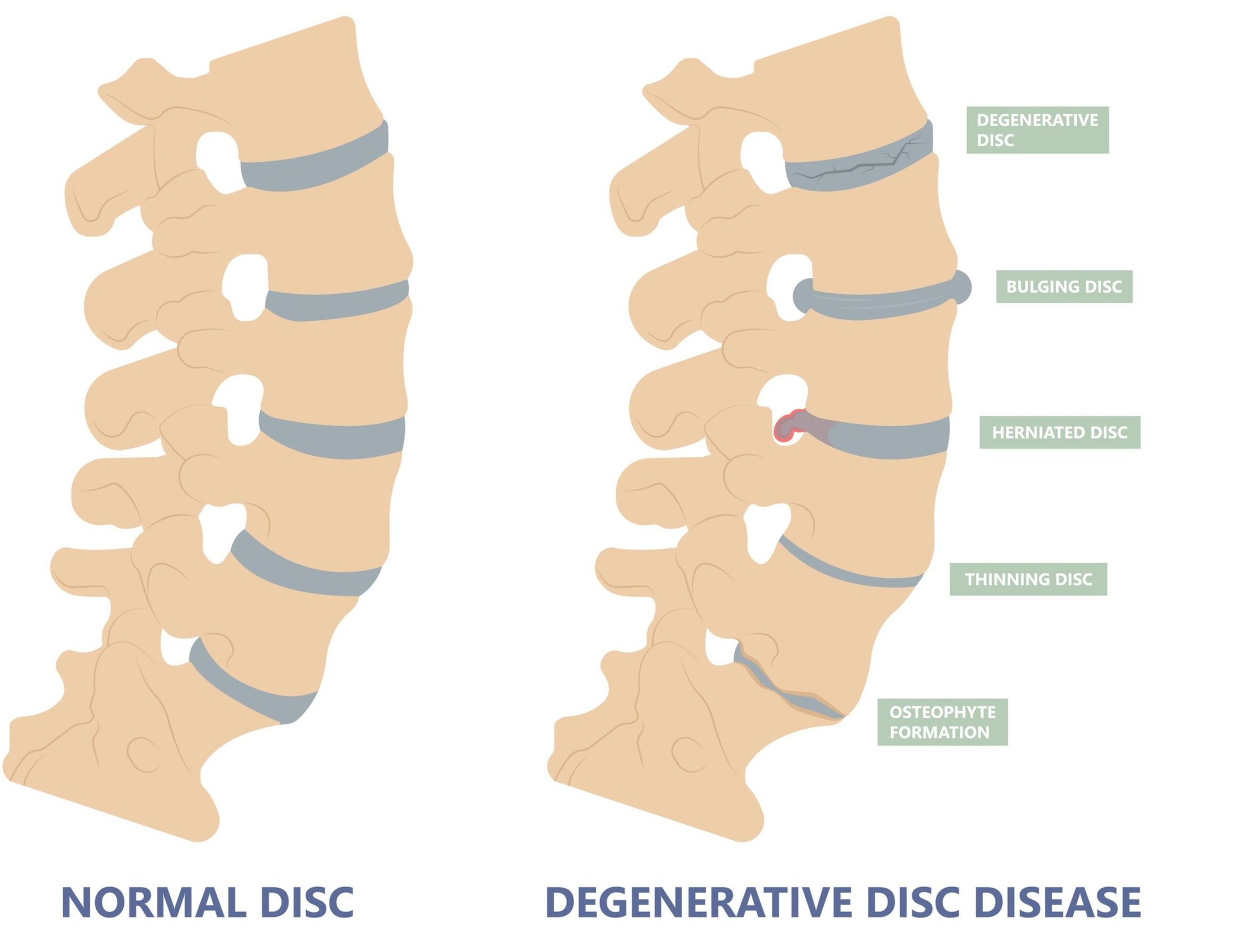 What are Intervertebral Discs and How Chiropractic Care Can Help Prevent Degeneration