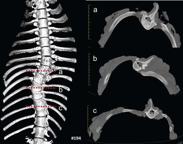 Understanding Spinal Deformity in Scoliosis - Scoliosis article from Lake Nona Chiropractic