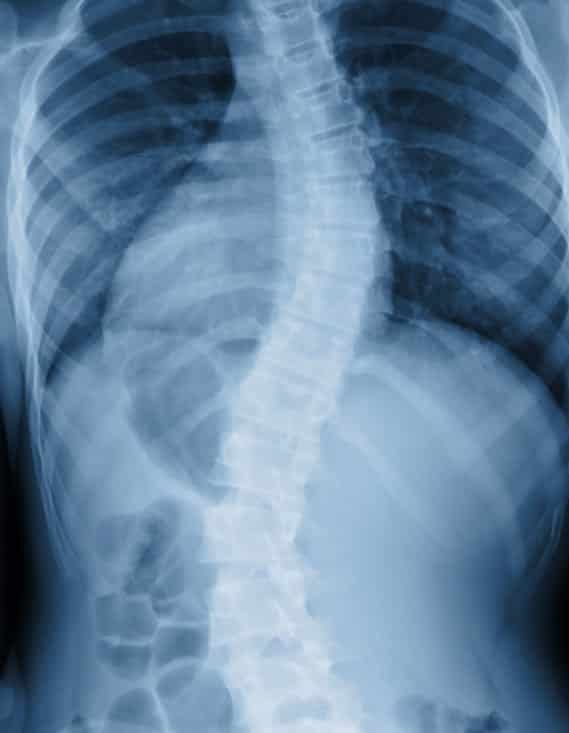 Spine X-ray showing disc herniation reviewed at Lake Nona Chiropractic