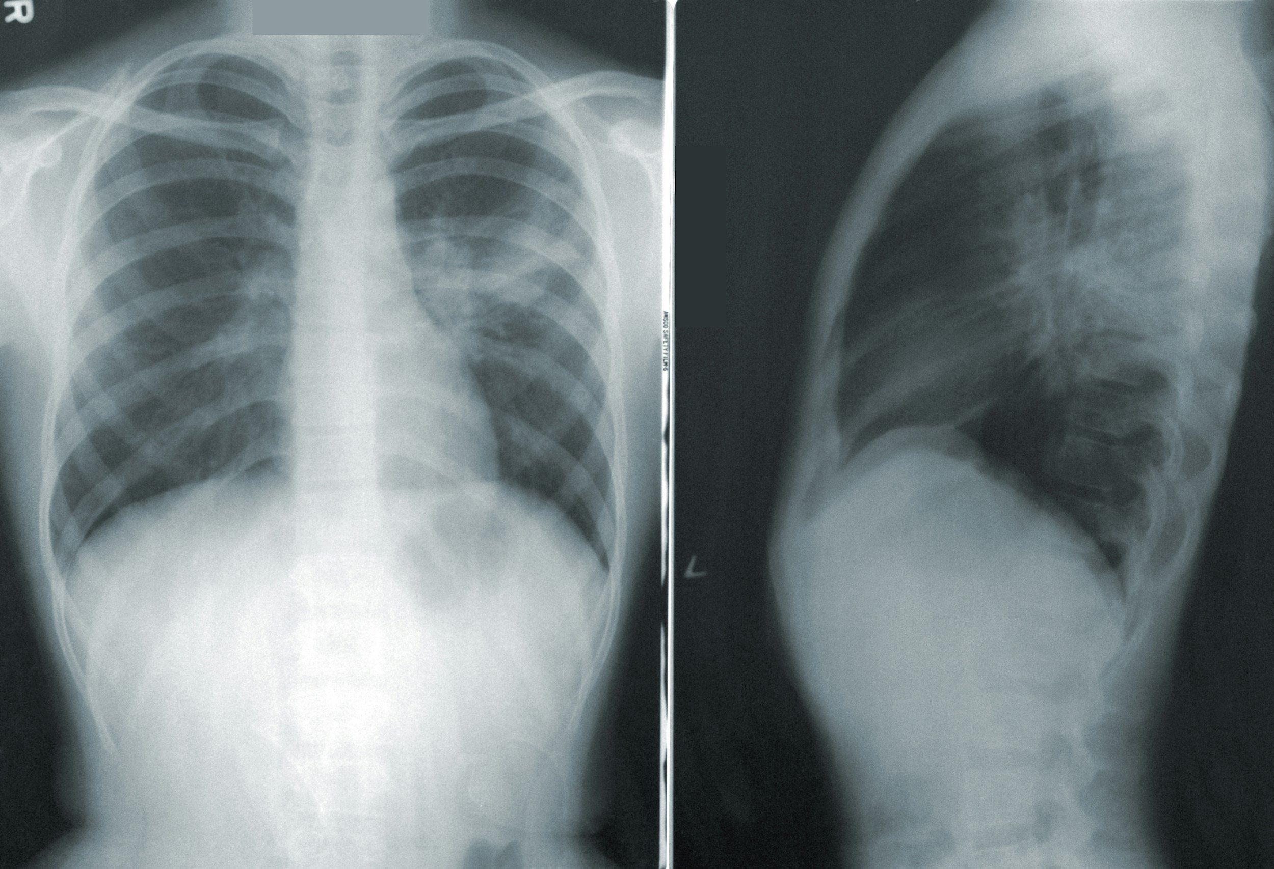 Are Spinal X-Rays Safe? What the Research Shows - Chiropractic article from Lake Nona Chiropractic