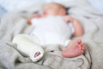 Clubfoot