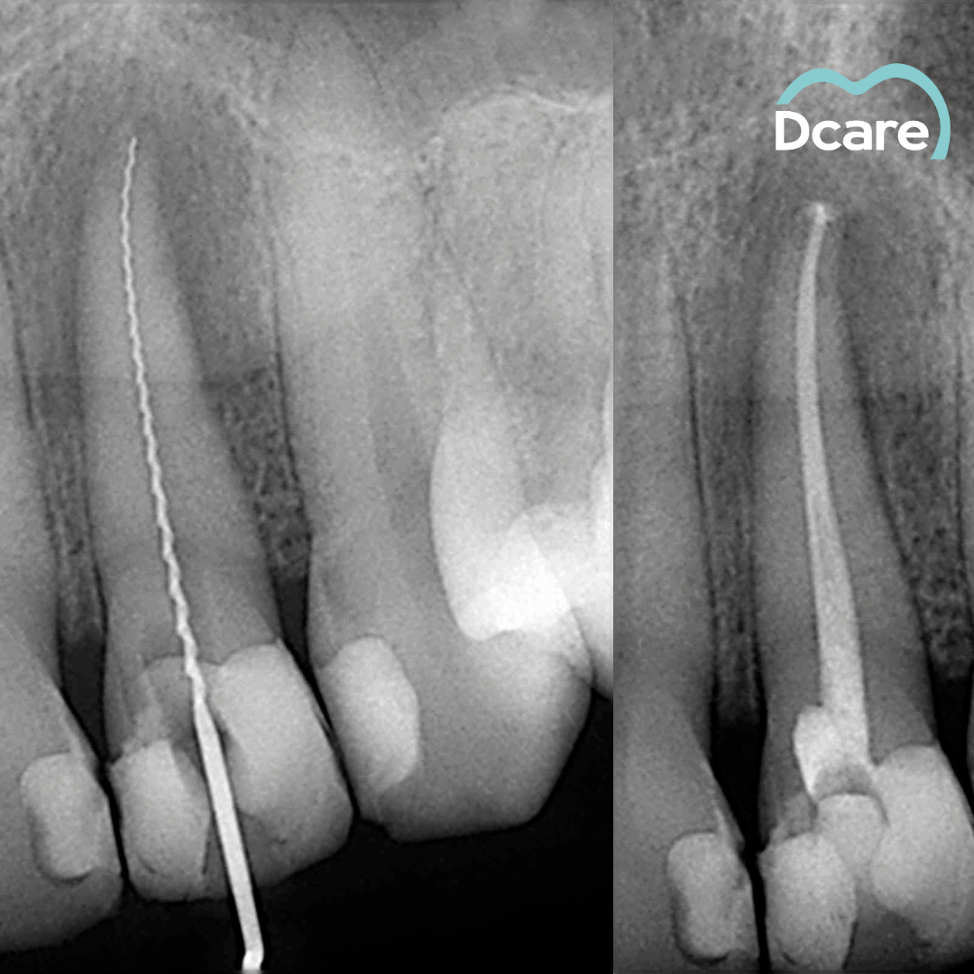 Endodoncia