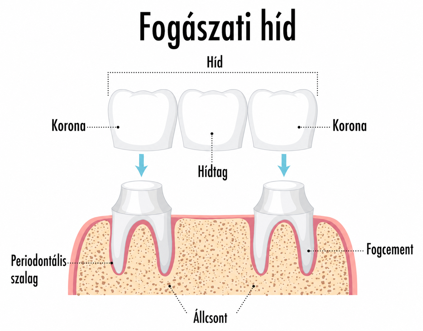 Fogászati híd és koronák szemléltető ábrája