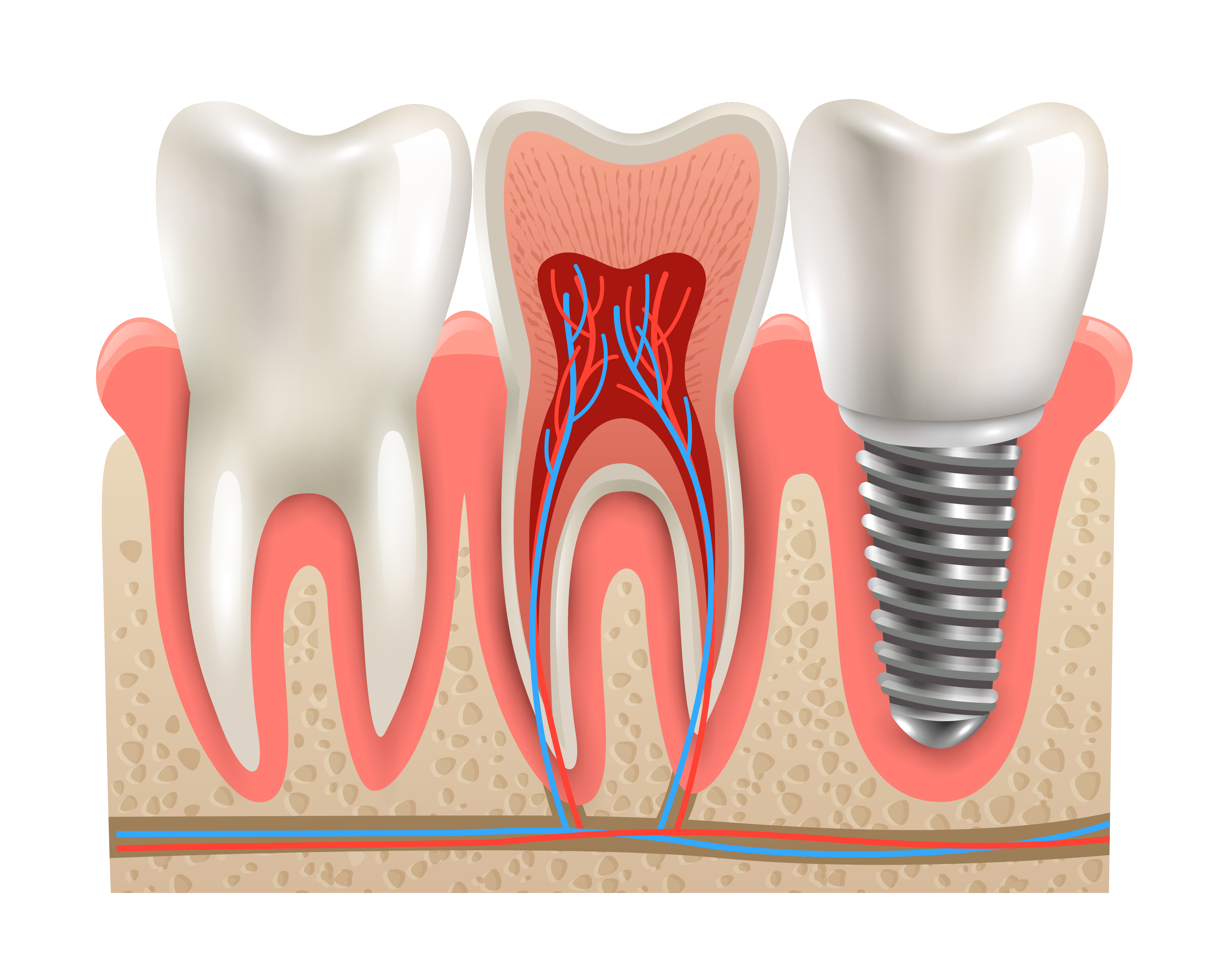 Illustration of a dental implant