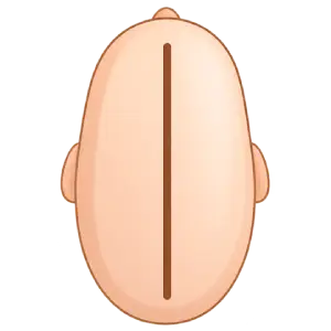 Ilustração representando Escafocefalia, tipo de assimetria craniana