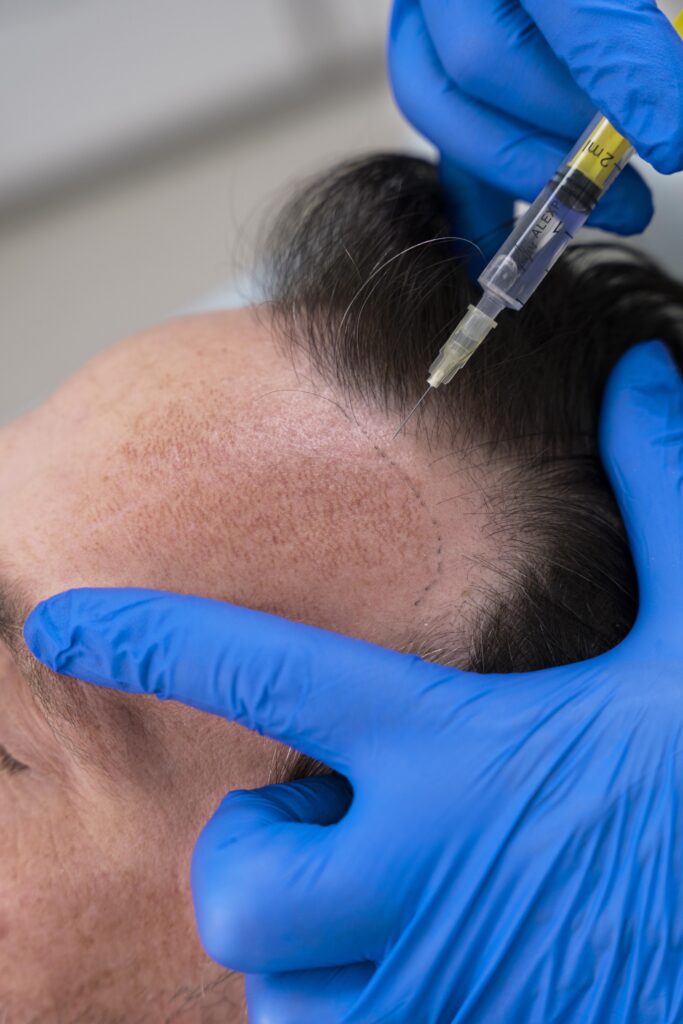Hair restoration consultation at Vizage Aesthetic Center serving Medley, FL