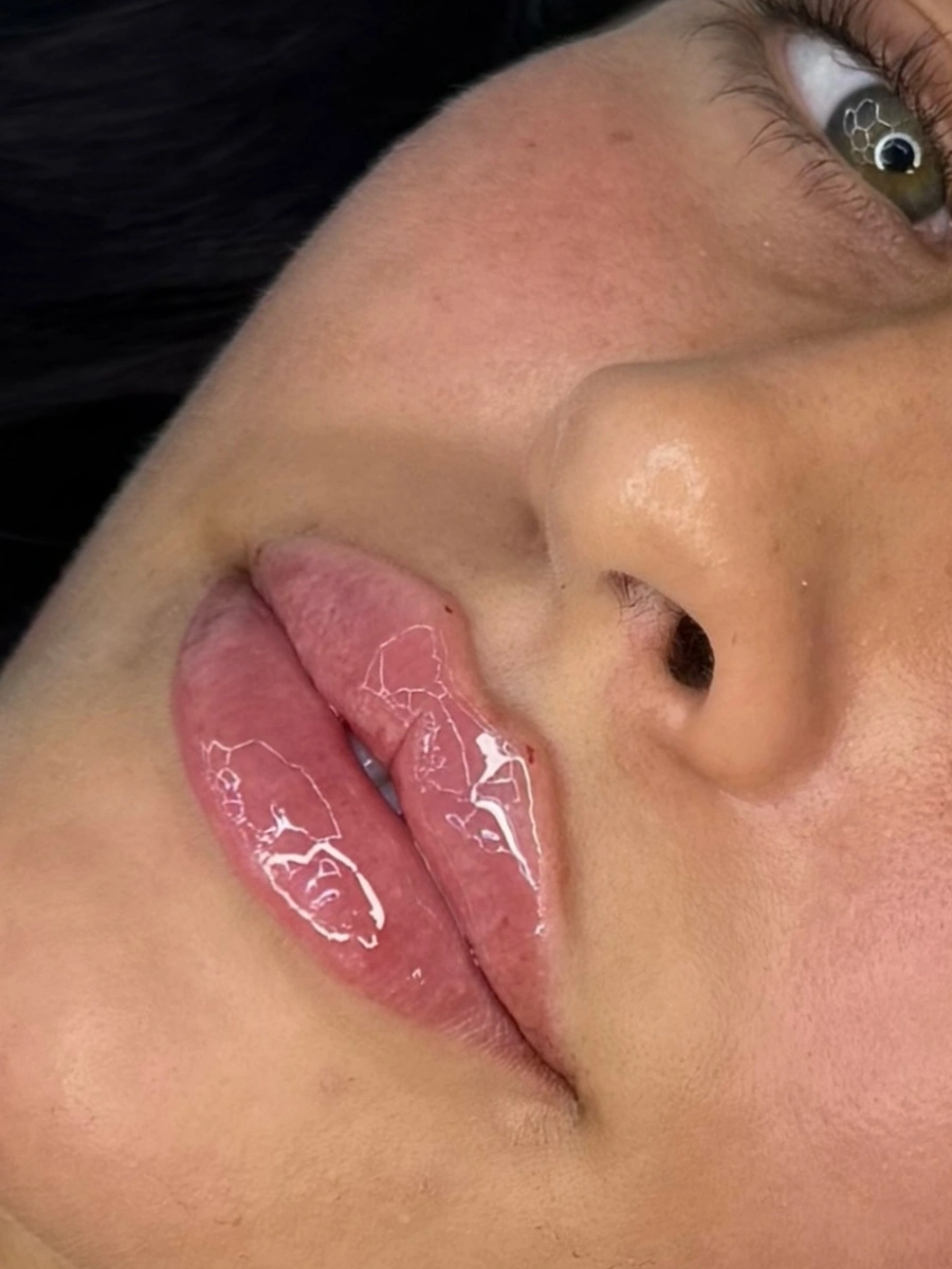 Real Lip Filler Result 6 at Burns Salon Luton