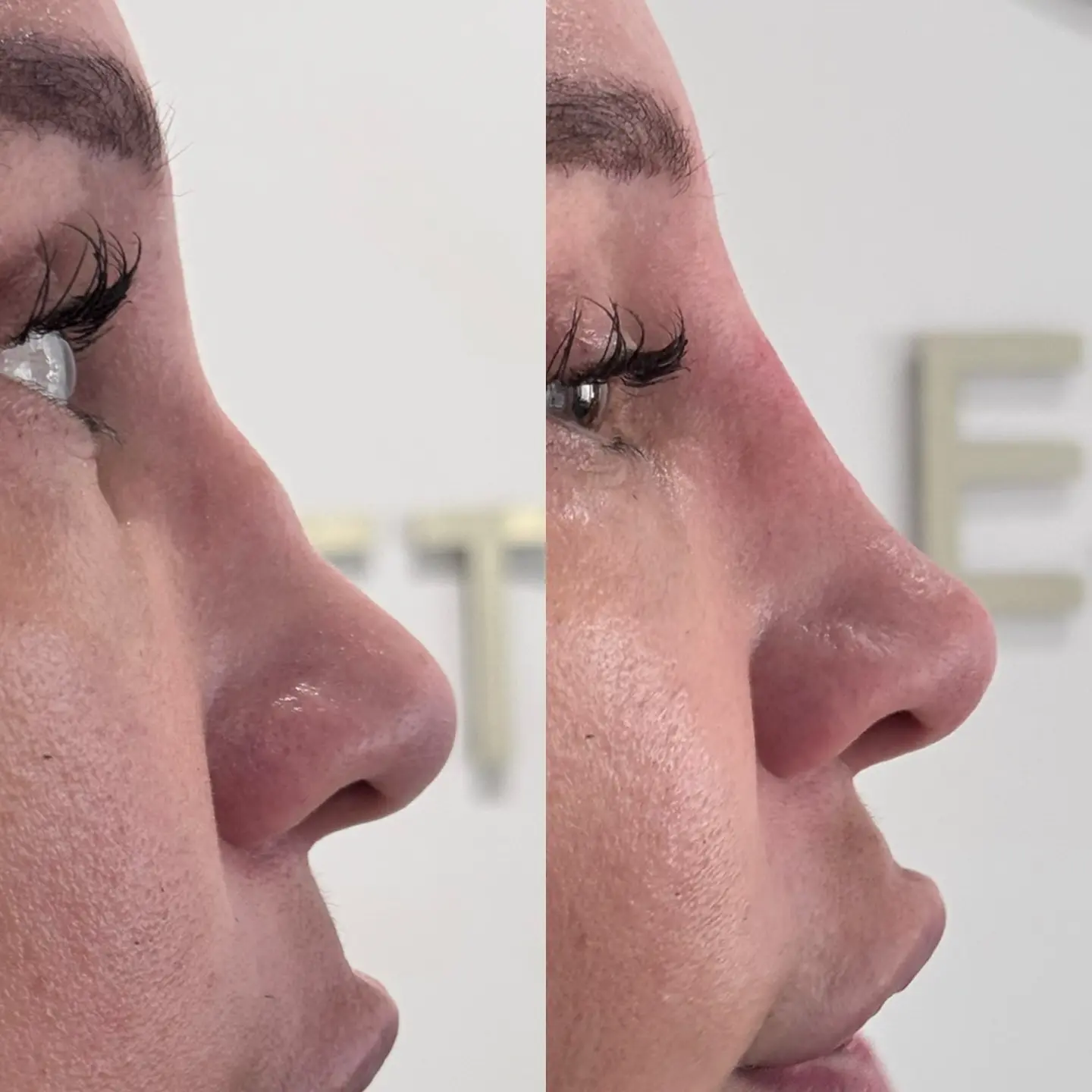 Non-Surgical Rhinoplasty profile straightening before and after at Burns Salon Luton