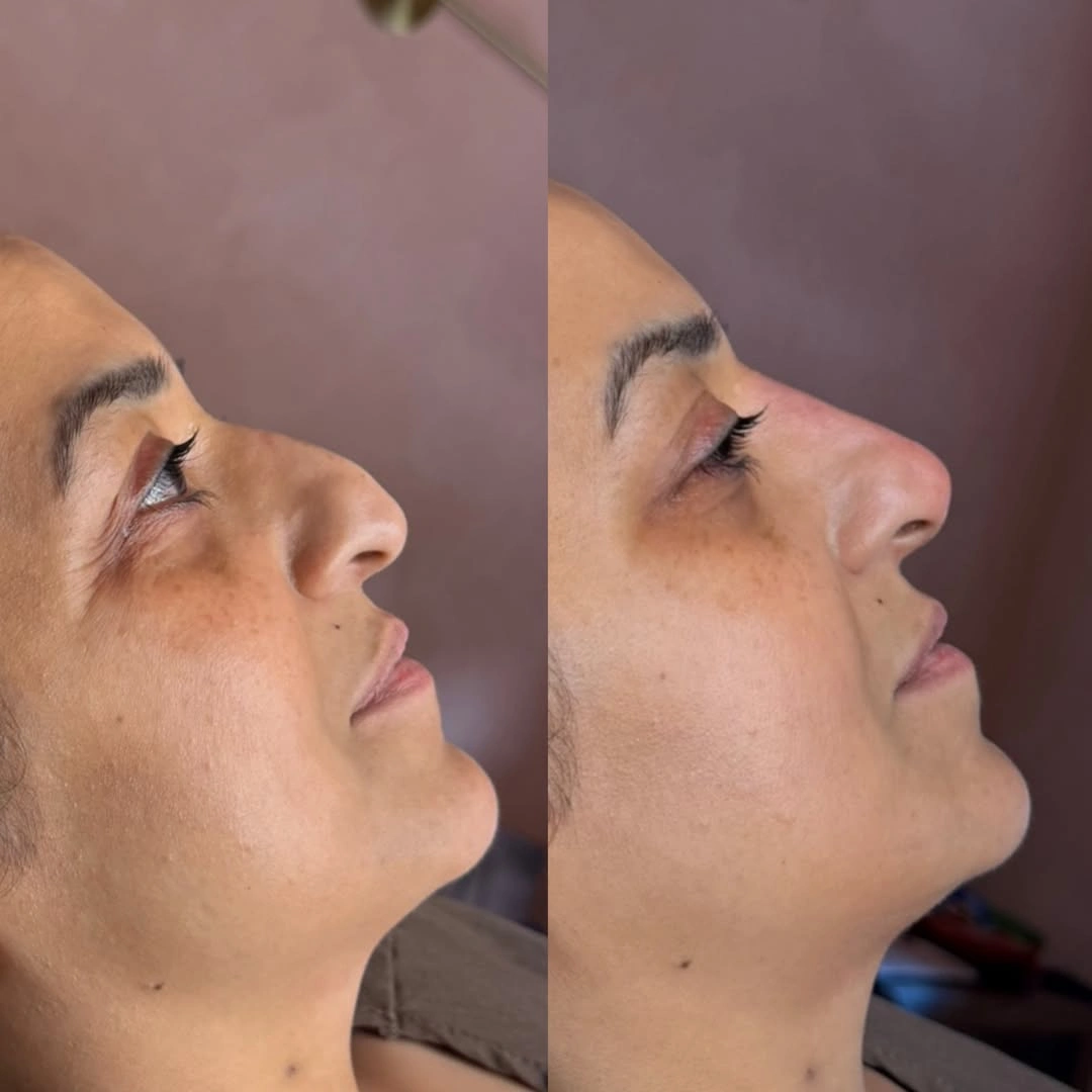 Non-Surgical Rhinoplasty nose reshaping and bridge refinement before and after at Burns Salon Luton