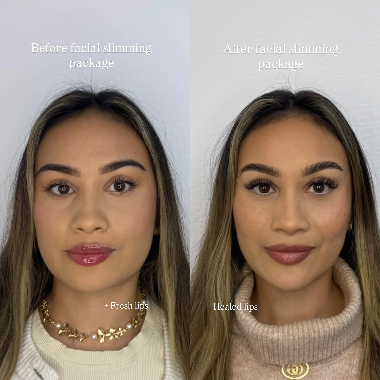 Real Facial Slimming Result 4 at Burns Salon Luton