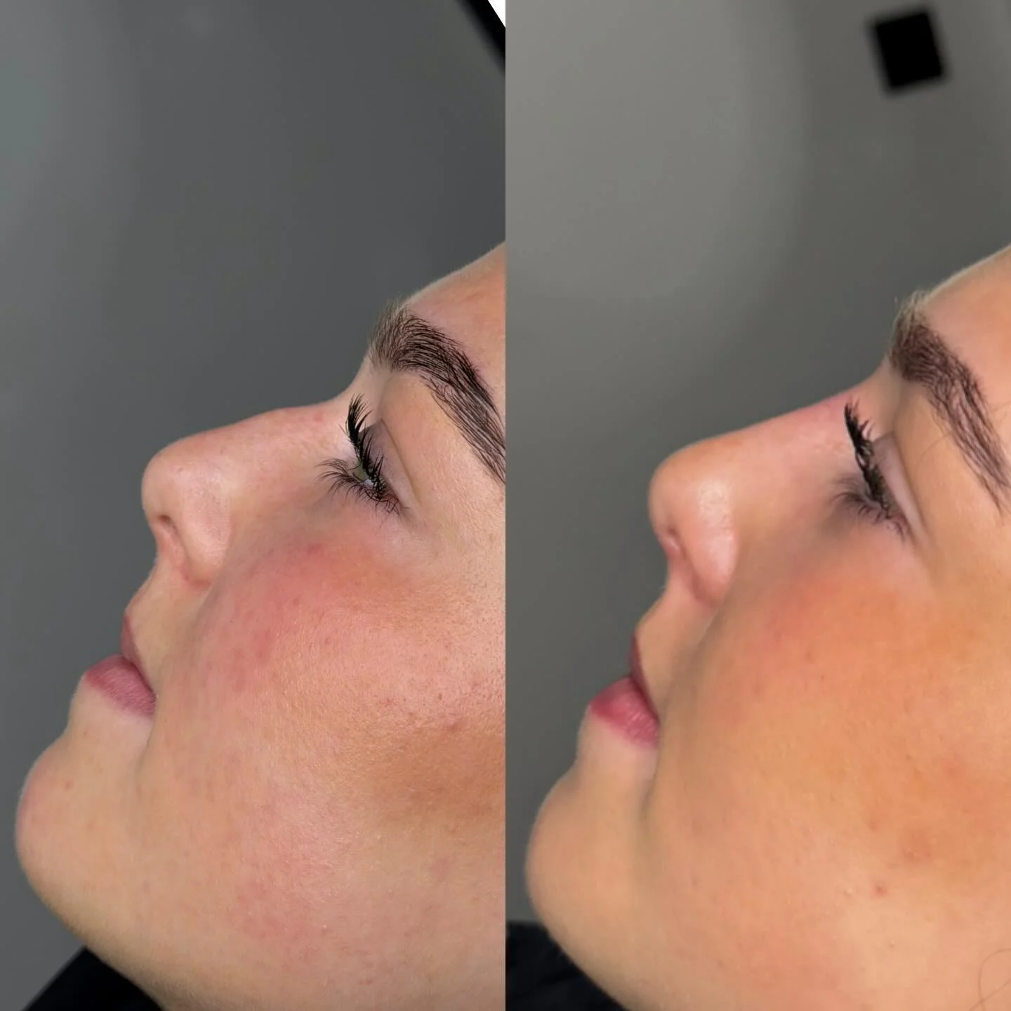 Non-Surgical Rhinoplasty natural nose contouring before and after at Burns Salon Luton