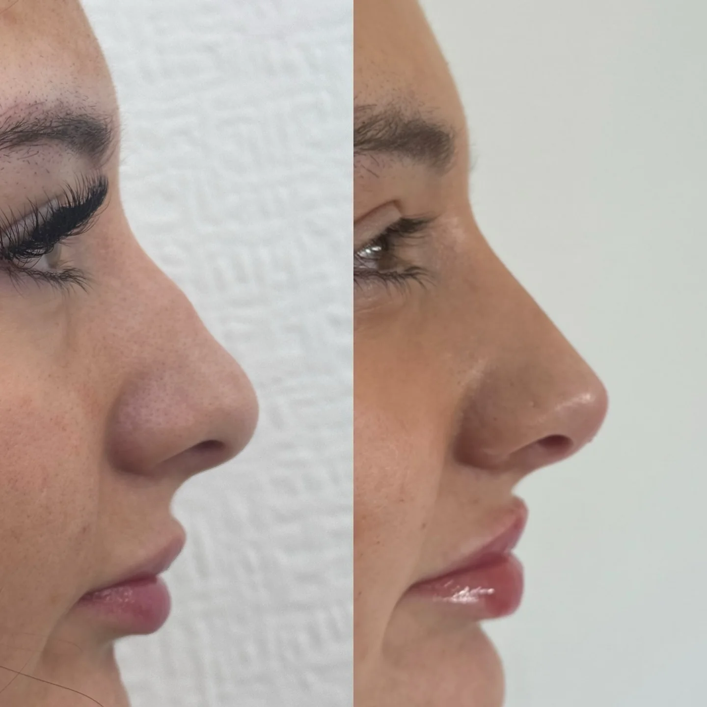 Real Non-Surgical Rhinoplasty Result 4 at Burns Salon Luton