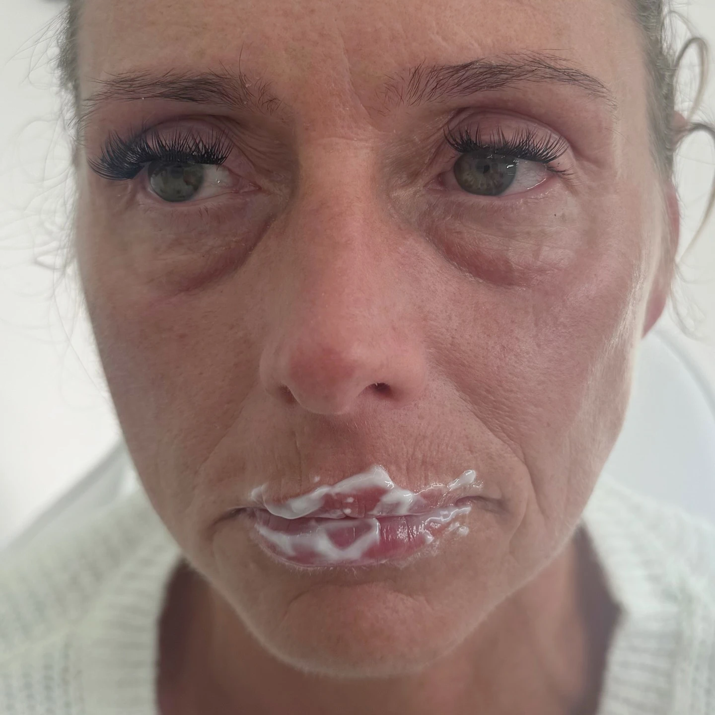 Tear trough filler under-eye hollow smoothing before and after transformation at Burns Salon Luton - Before