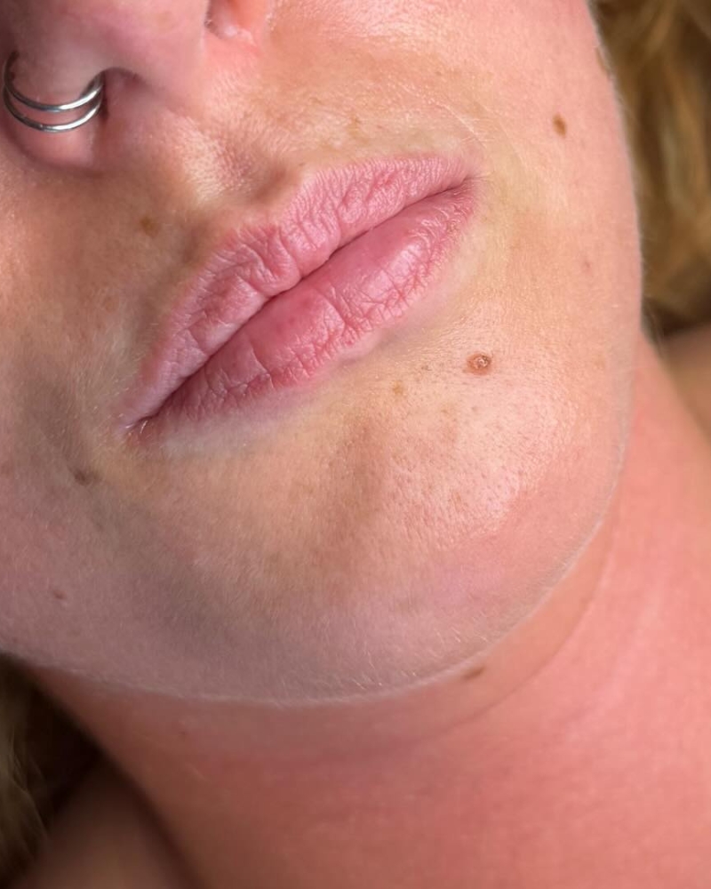Lip Reset Before Treatment