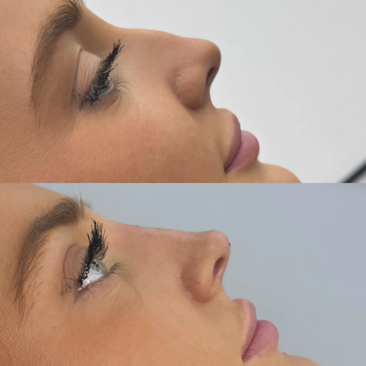 Real Non-Surgical Rhinoplasty Result 3 at Burns Salon Luton
