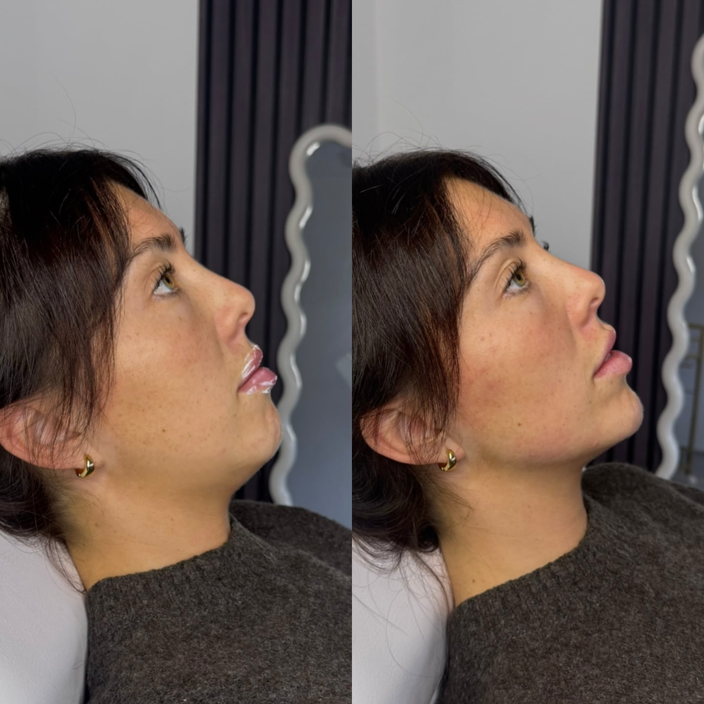 Chin & Jaw Filler at Burns Salon