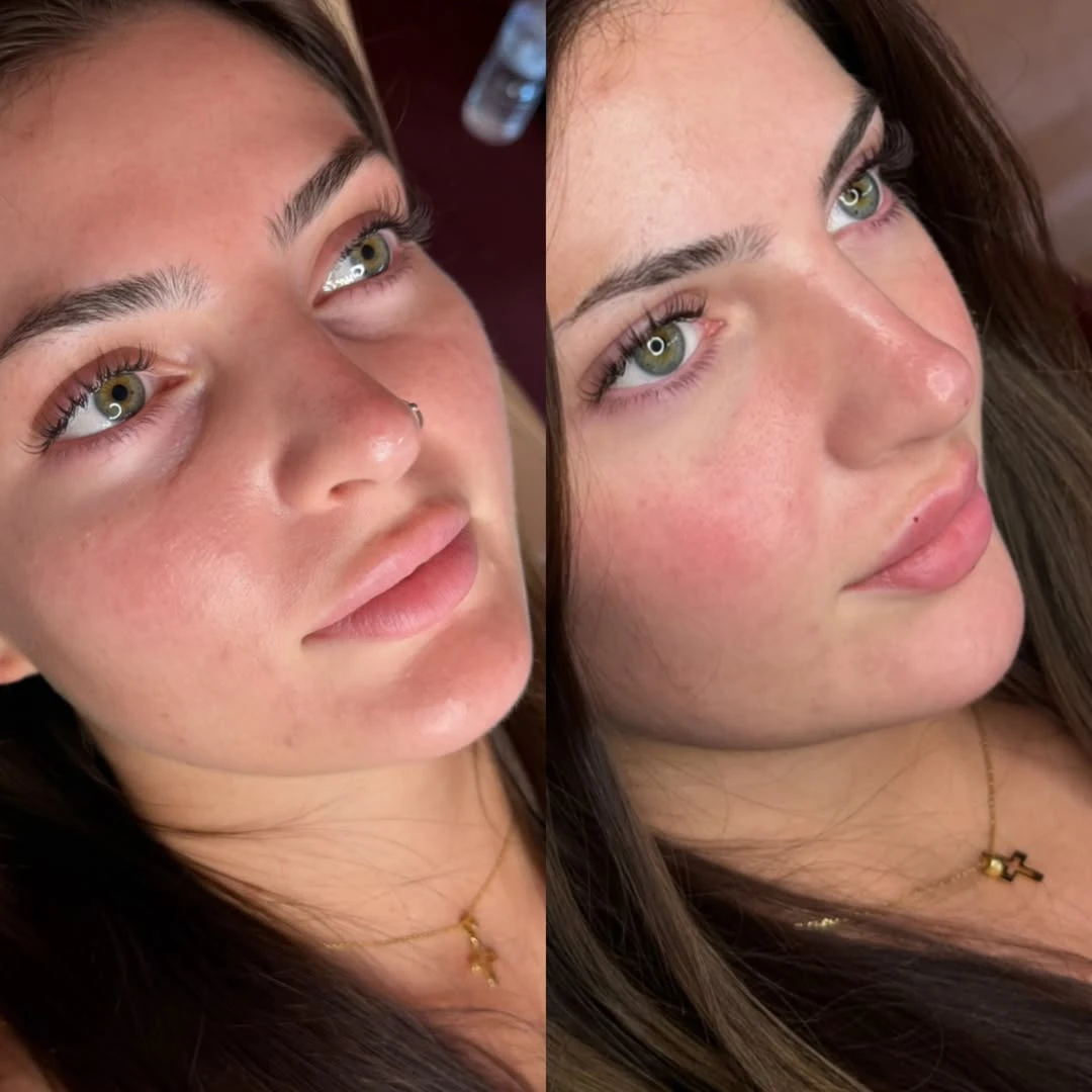 Real Tear Trough Result 2 at Burns Salon Luton
