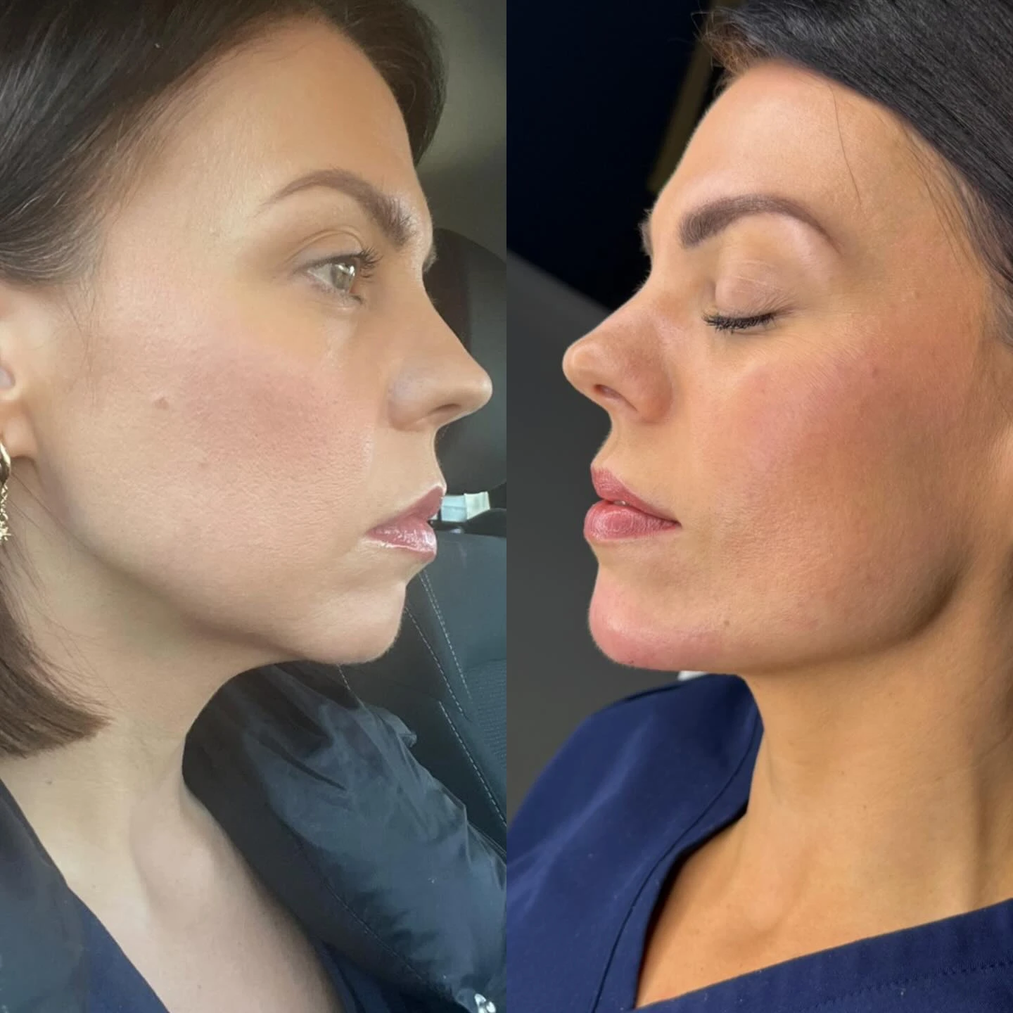 Facial slimming masseter anti-wrinkle injections and chin filler treatment in progress at Burns Salon Luton