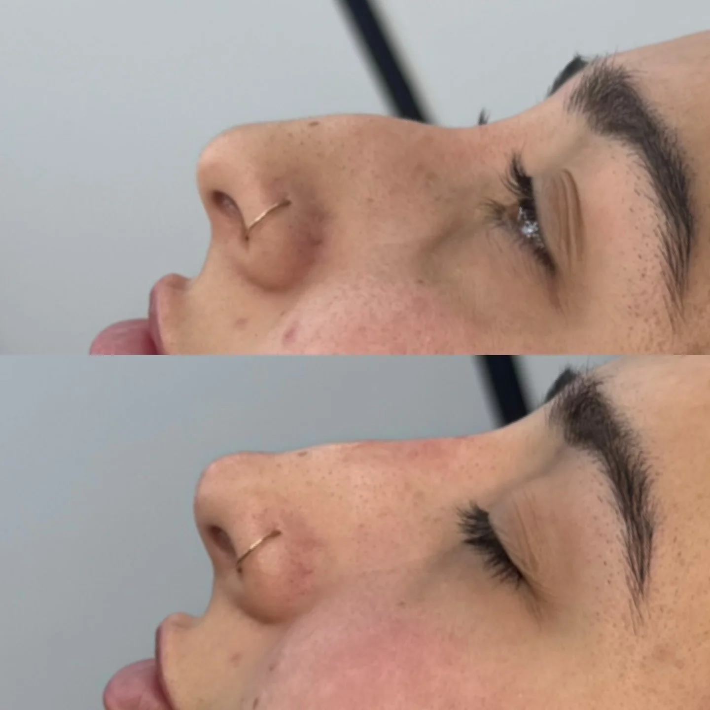 Real Non-Surgical Rhinoplasty Result 6 at Burns Salon Luton