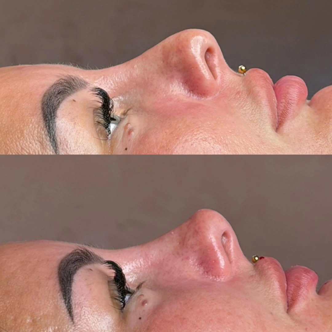 Non-Surgical Rhinoplasty nasal bridge straightening before and after at Burns Salon Luton