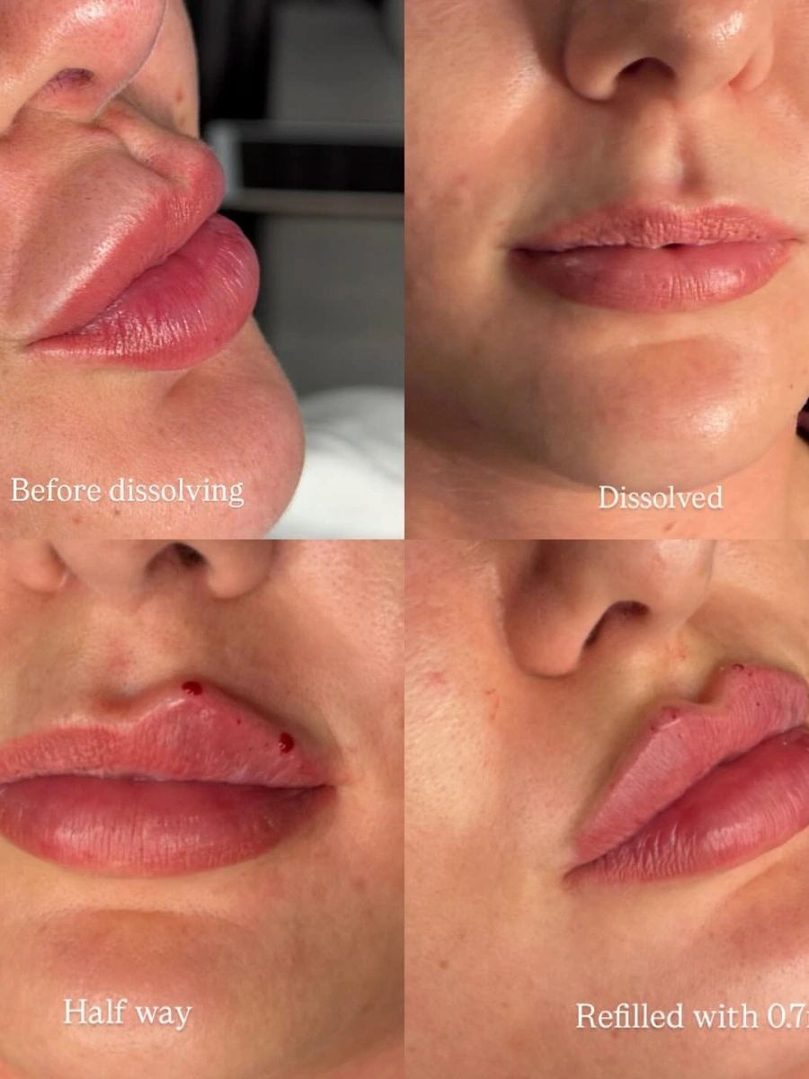 Dissolve & 0.7ml Refill - Overfilled profile to crisp contour