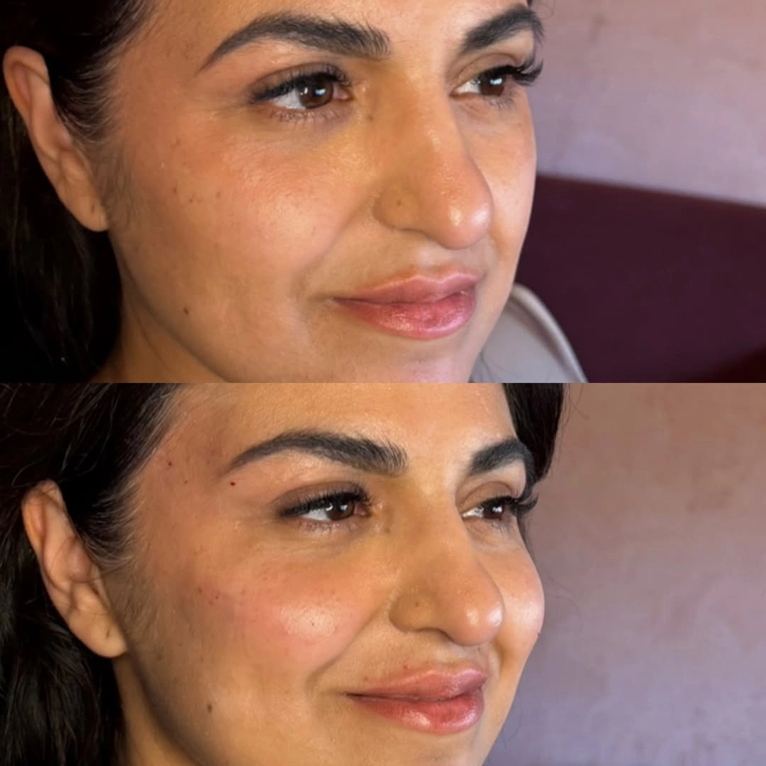 Cheek filler restoring mid-face volume and cheekbone definition at Burns Salon Luton