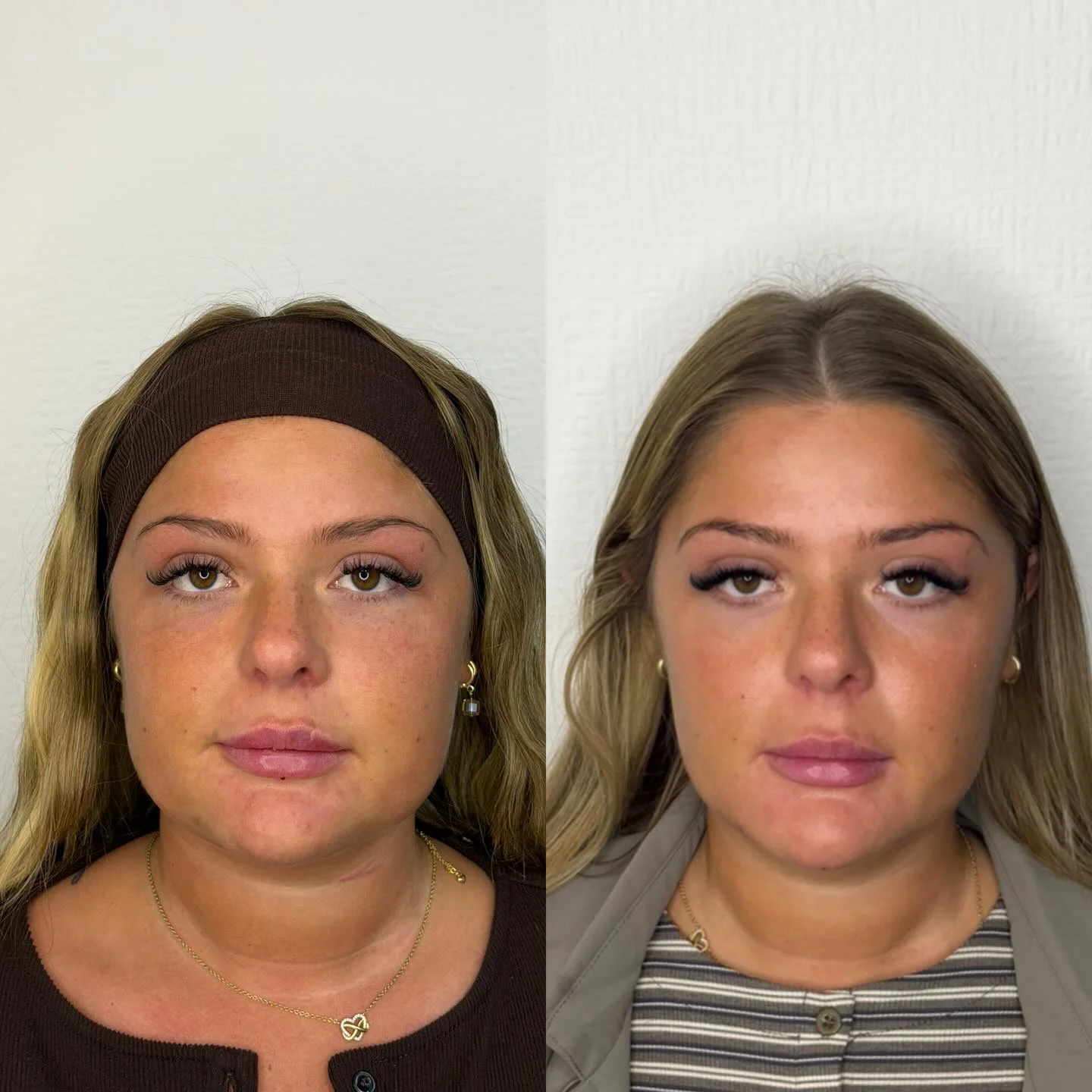 Real Facial Slimming Result 3 at Burns Salon Luton