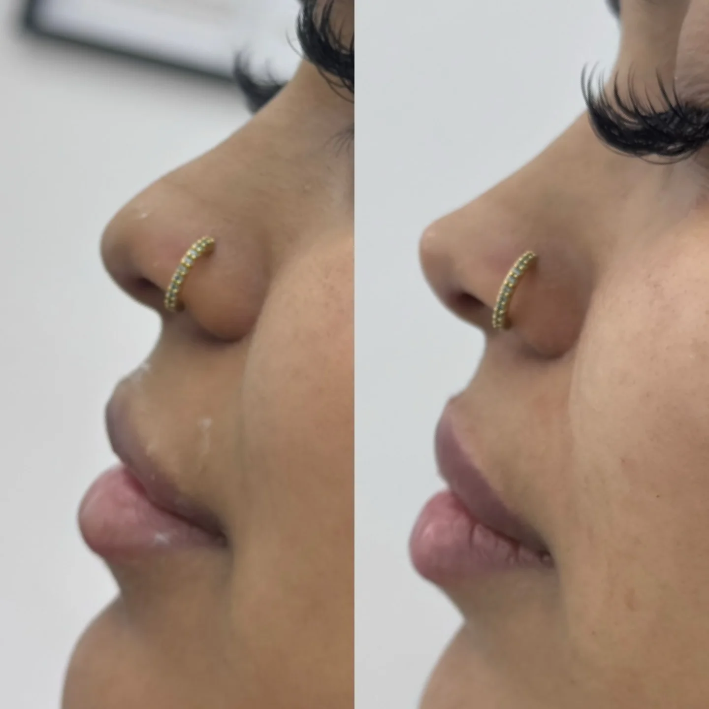 Real Non-Surgical Rhinoplasty Result 1 at Burns Salon Luton