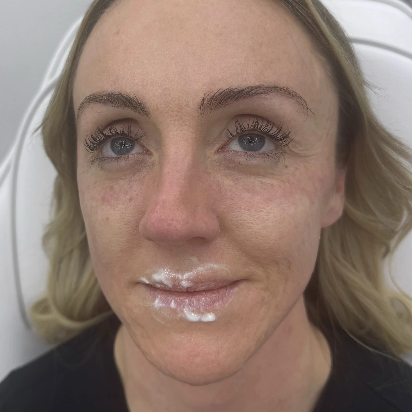 Tear trough treatment dark circle and under-eye smoothing before and after transformation at Burns Salon Luton - Before