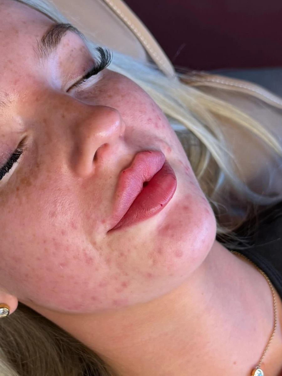 Real Lip Filler Result 16 at Burns Salon Luton
