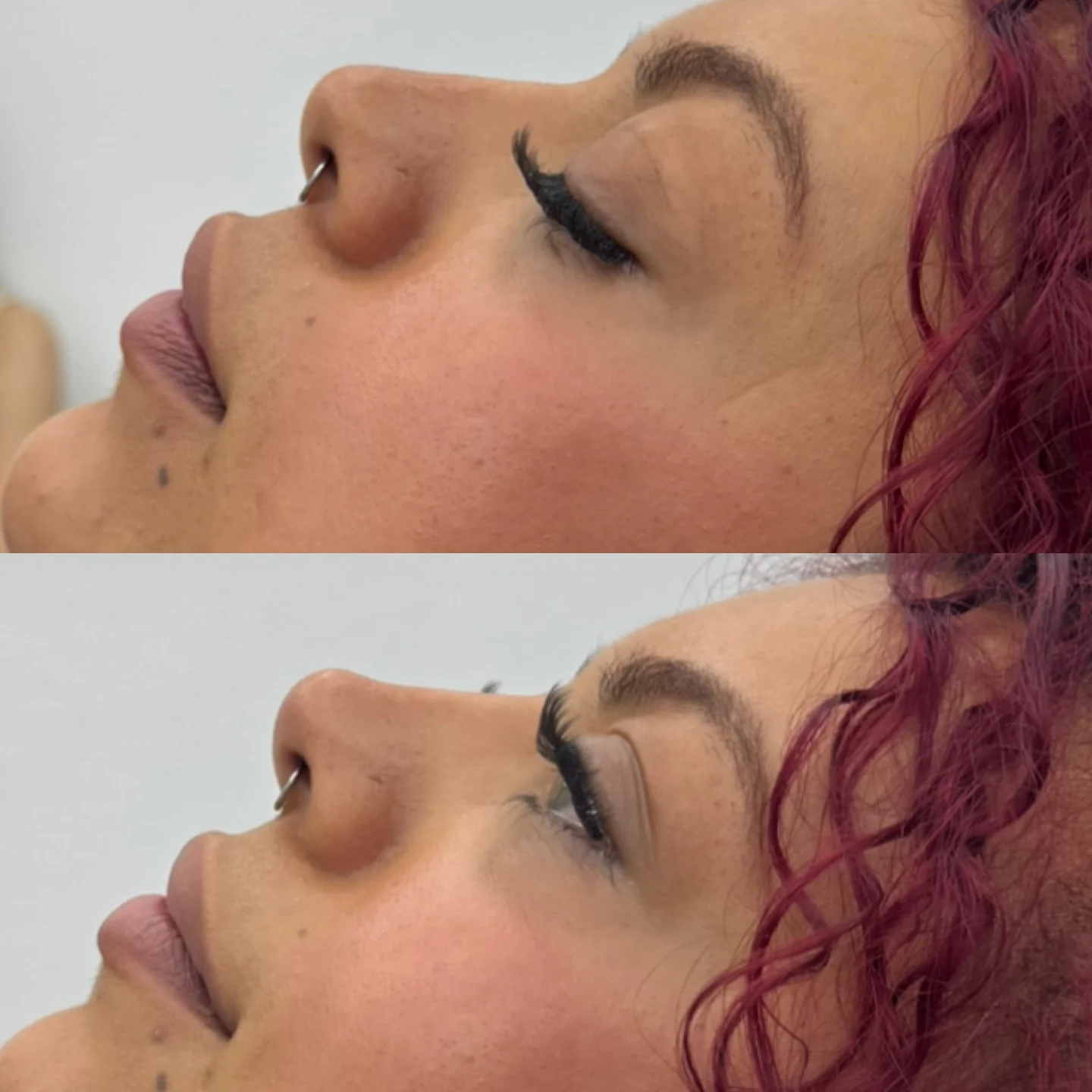 Real Non-Surgical Rhinoplasty Result 11 at Burns Salon Luton