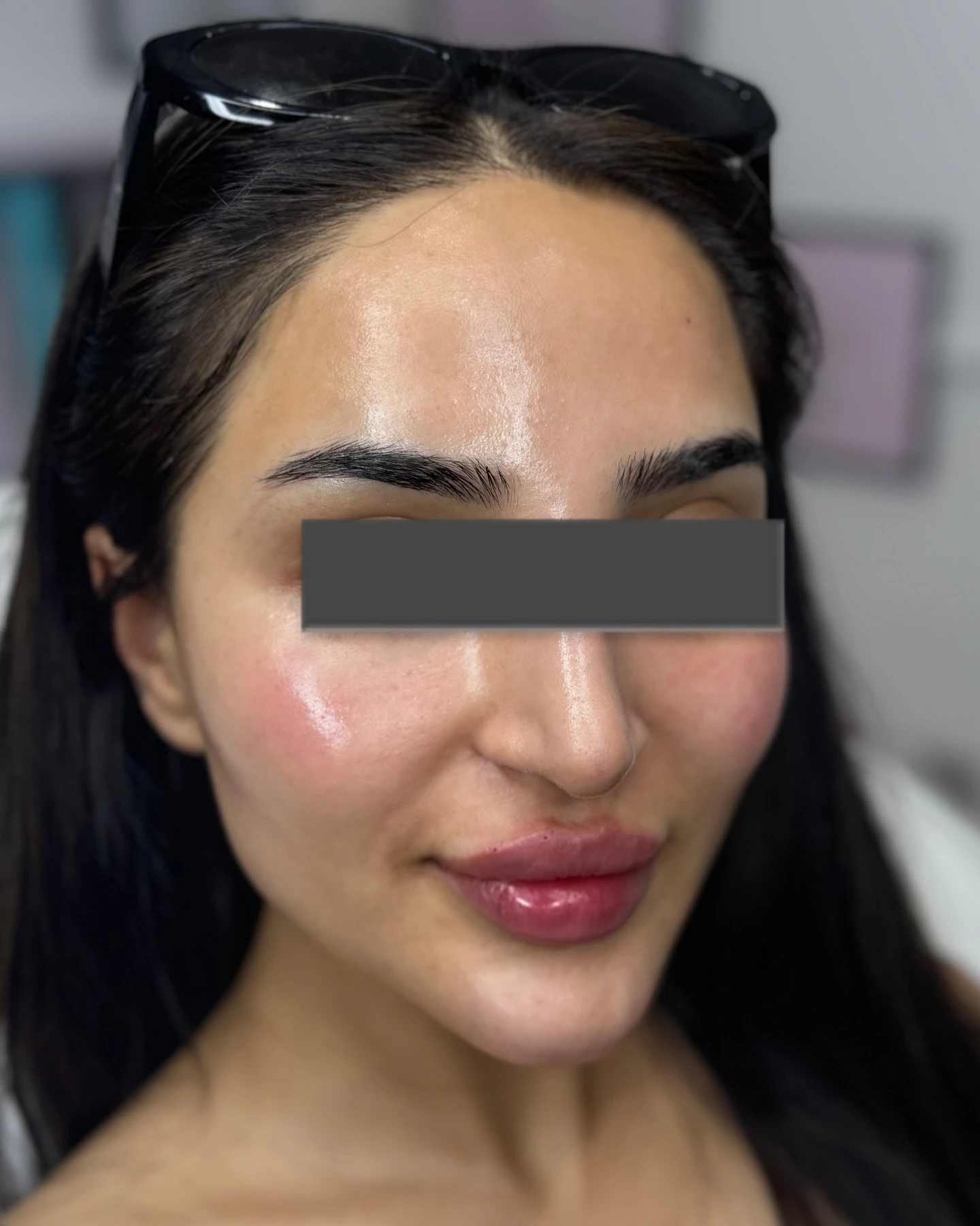 Cheek filler cannula technique treatment in progress at Burns Salon Luton