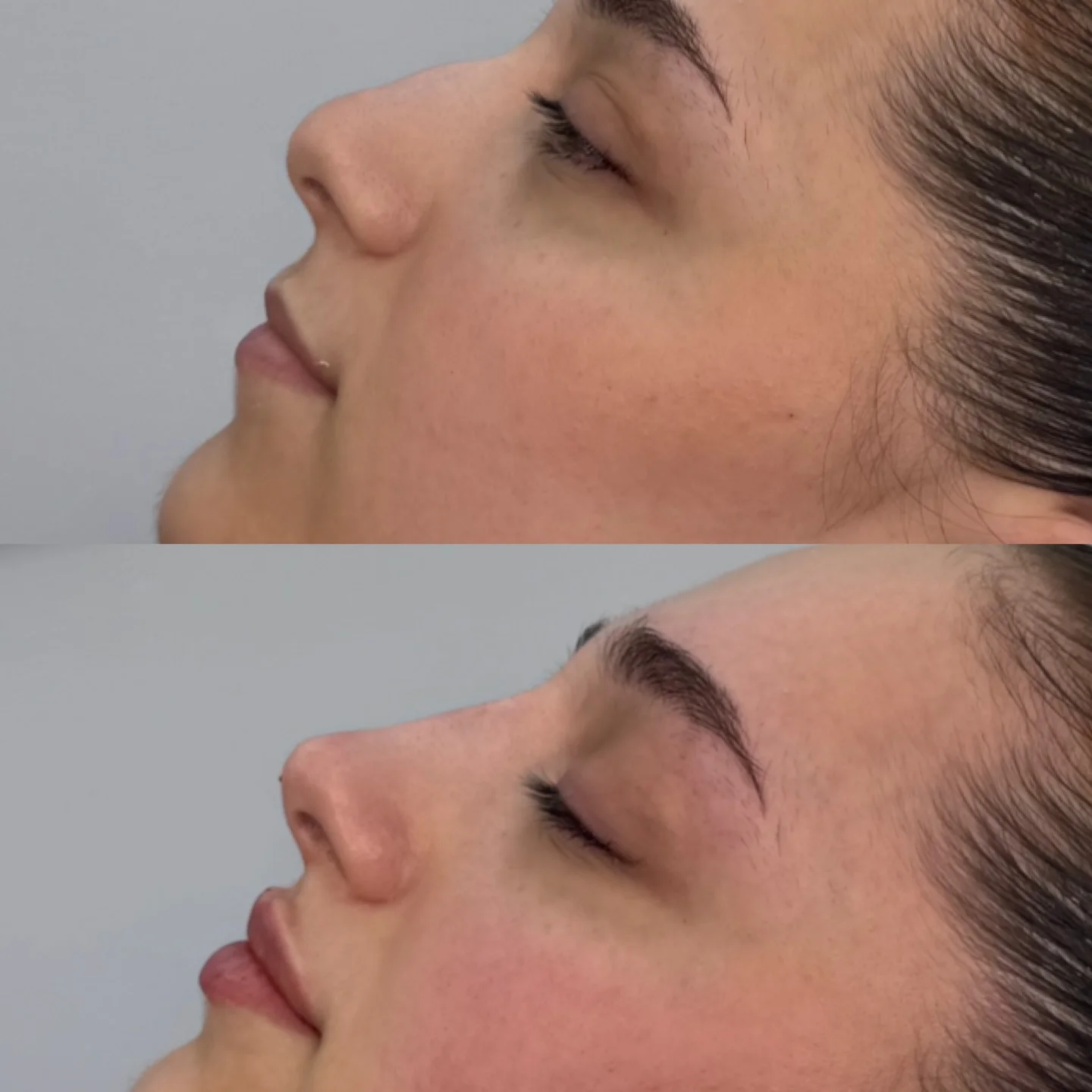 Non-Surgical Rhinoplasty bridge bump correction and tip refinement before and after at Burns Salon Luton