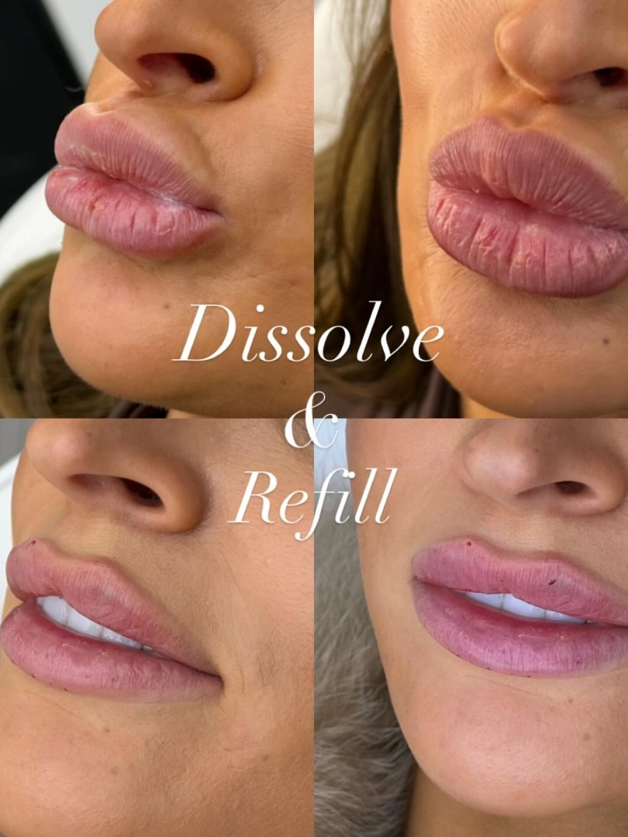 Lip Filler Dissolving at Burns Salon