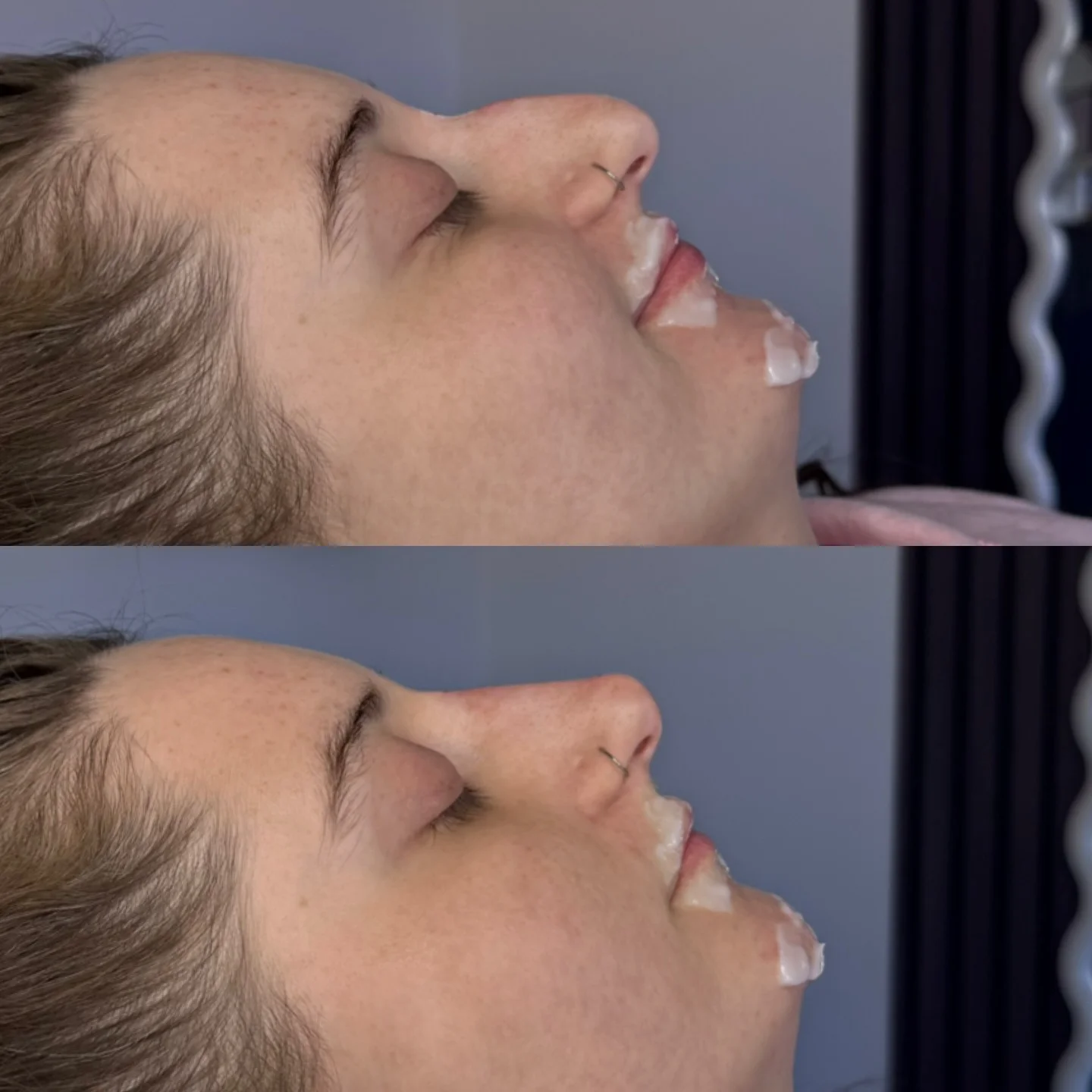 Real Non-Surgical Rhinoplasty Result 13 at Burns Salon Luton