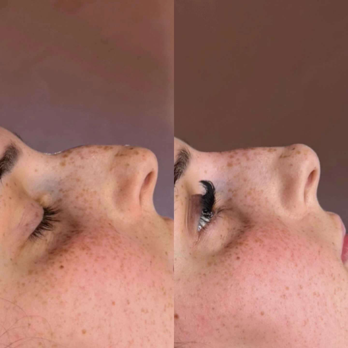 Non-Surgical Rhinoplasty dorsal hump reduction and profile balance at Burns Salon Luton