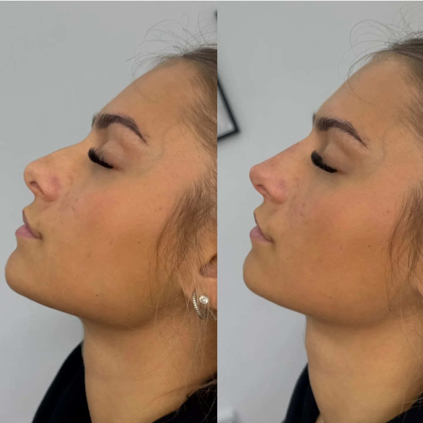 Real Non-Surgical Rhinoplasty Result 9 at Burns Salon Luton