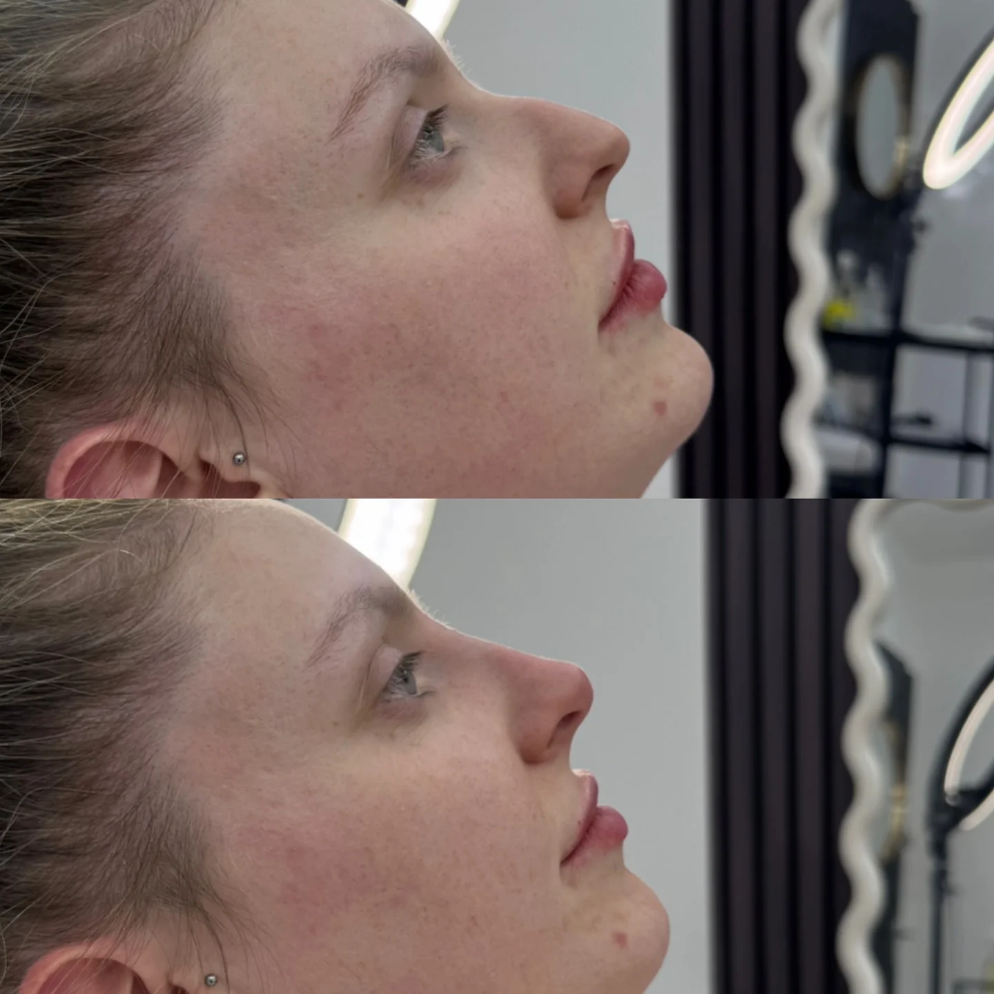 Real Non-Surgical Rhinoplasty Result 14 at Burns Salon Luton