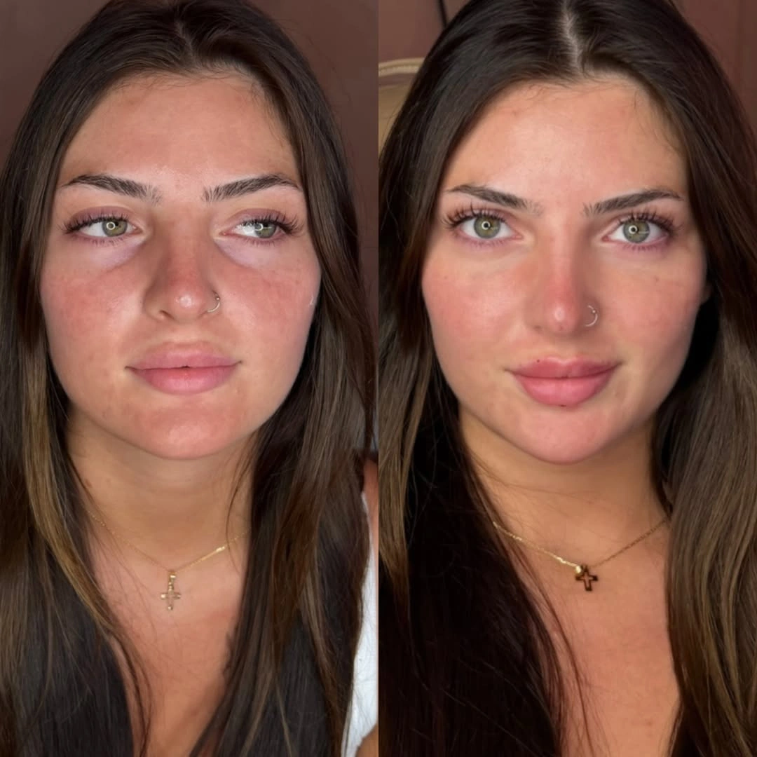 Tear Trough Treatment at Burns Salon