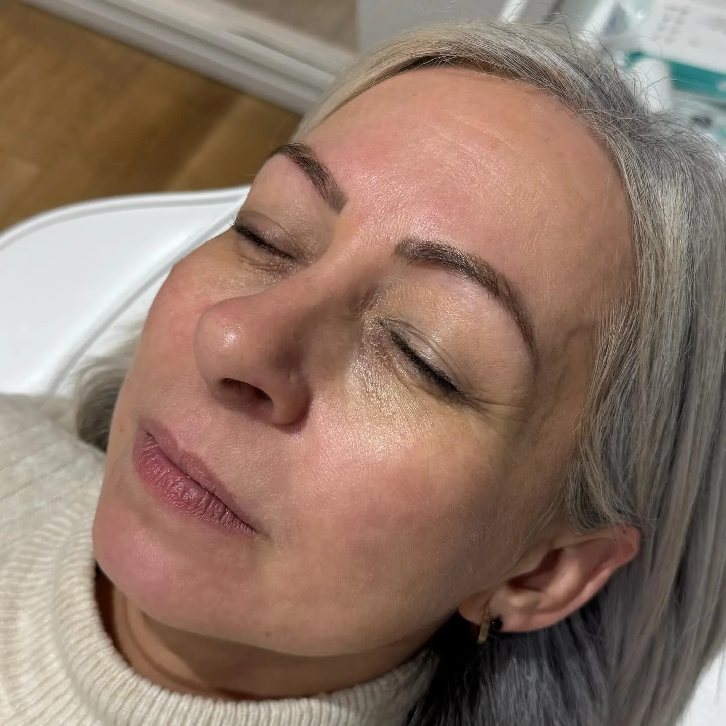 Under-eye filler rested refreshed look before and after at Burns Salon Luton - Before