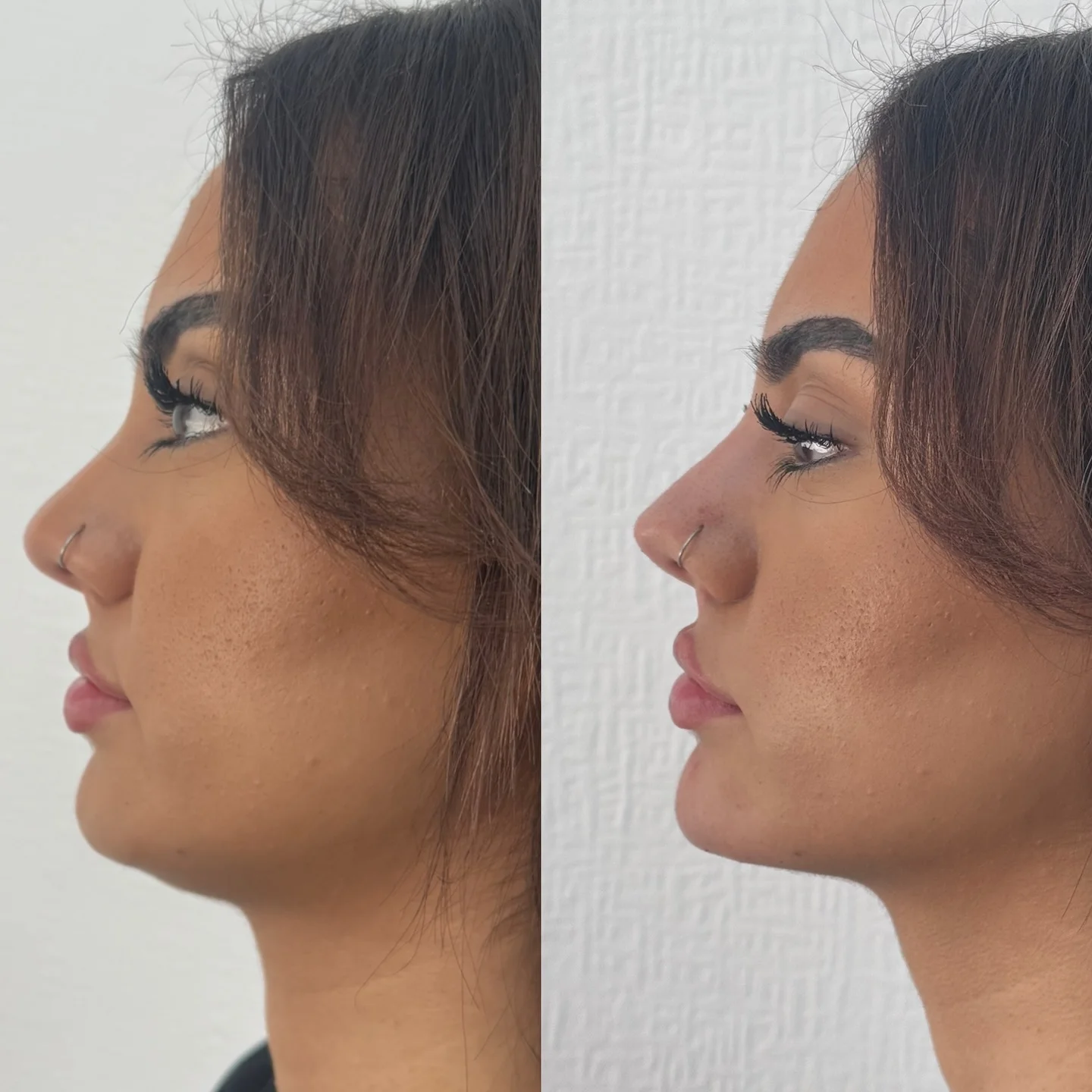 Non-surgical rhinoplasty dorsal bridge refinement consultation at Burns Salon Luton