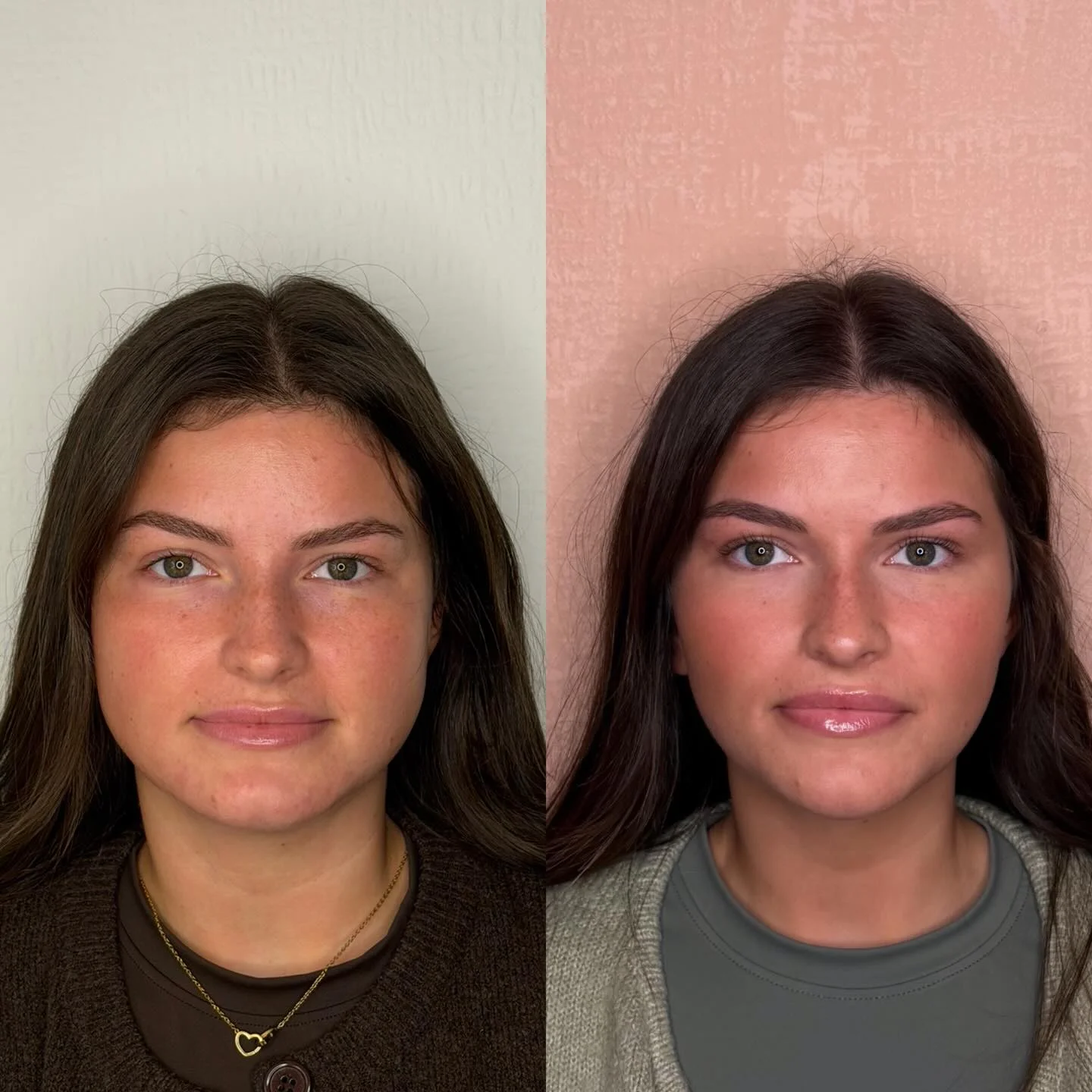 Real Facial Slimming Result 2 at Burns Salon Luton