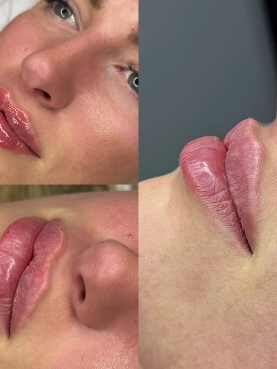 Real Lip Filler Result 8 at Burns Salon Luton