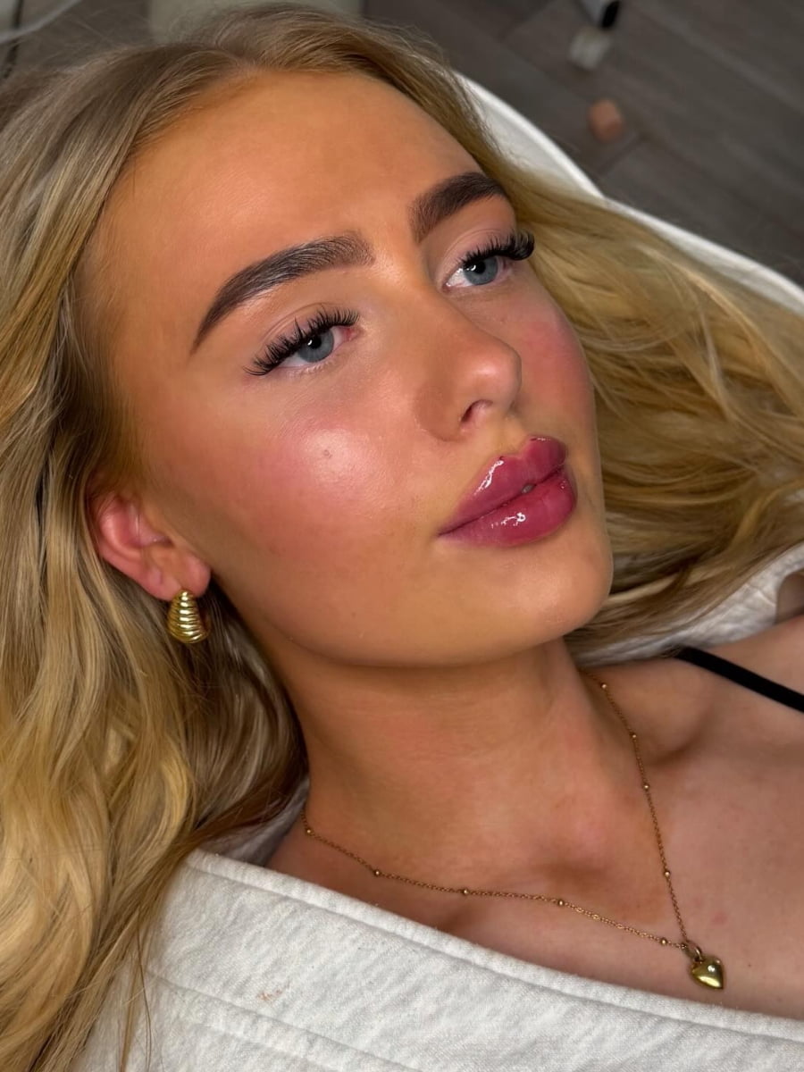 Real Lip Filler Result 12 at Burns Salon Luton