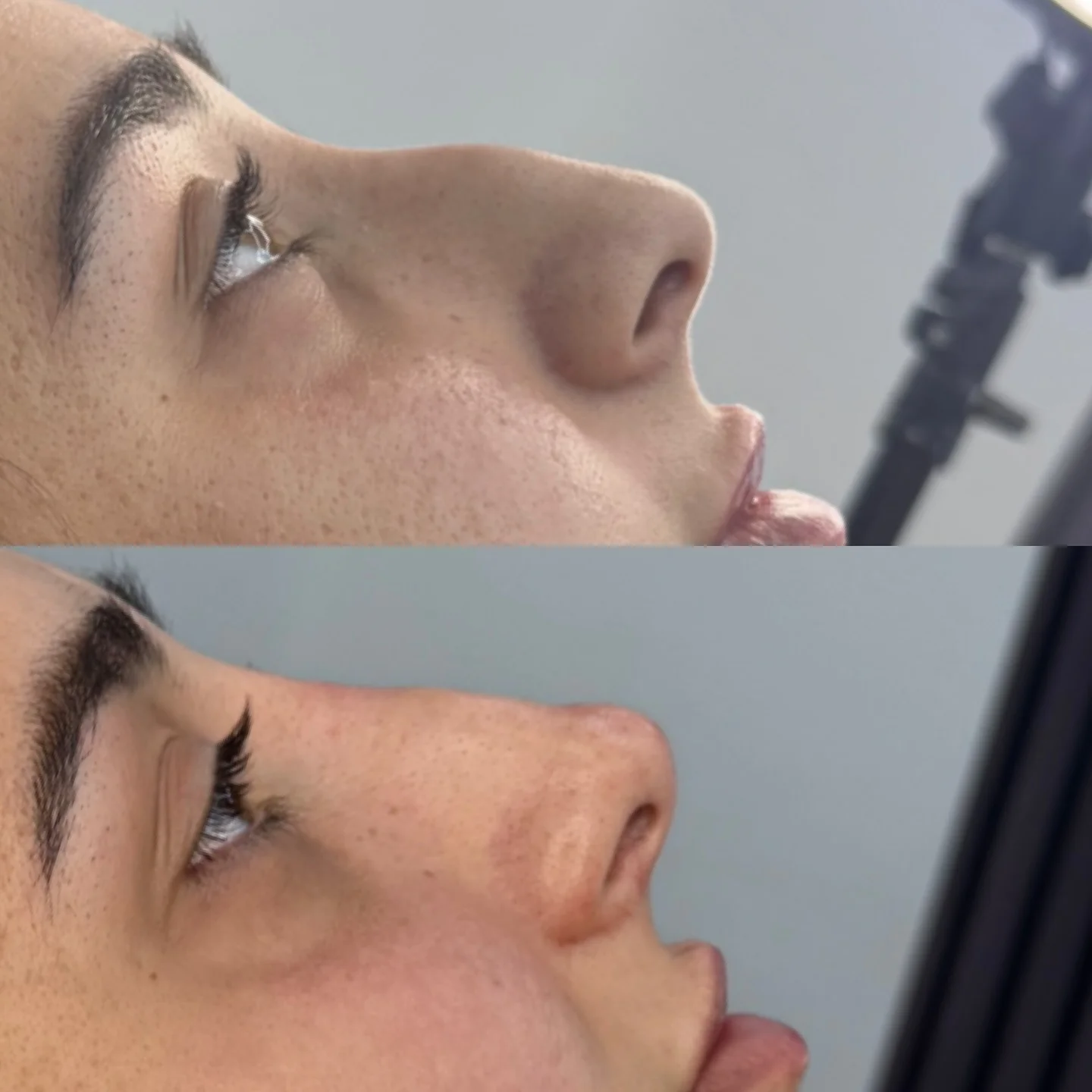Real Non-Surgical Rhinoplasty Result 7 at Burns Salon Luton