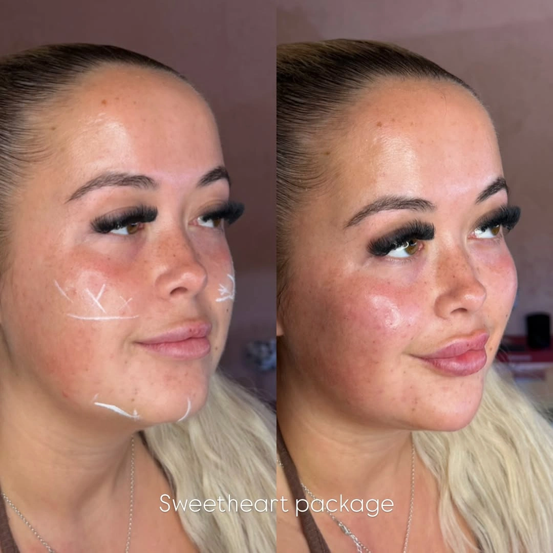 Cheek filler mid-face volume restoration before and after at Burns Salon Luton