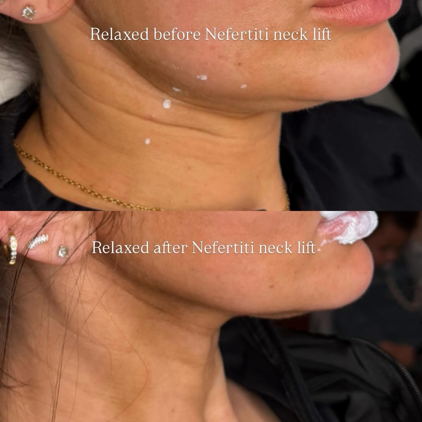 Anti-Wrinkle Injections at Burns Salon
