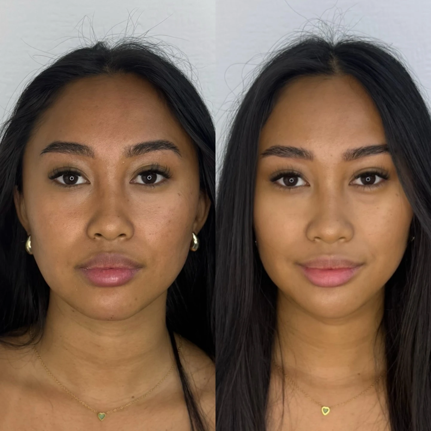 Facial slimming and balancing masseter anti-wrinkle injections and chin filler before and after at Burns Salon Luton