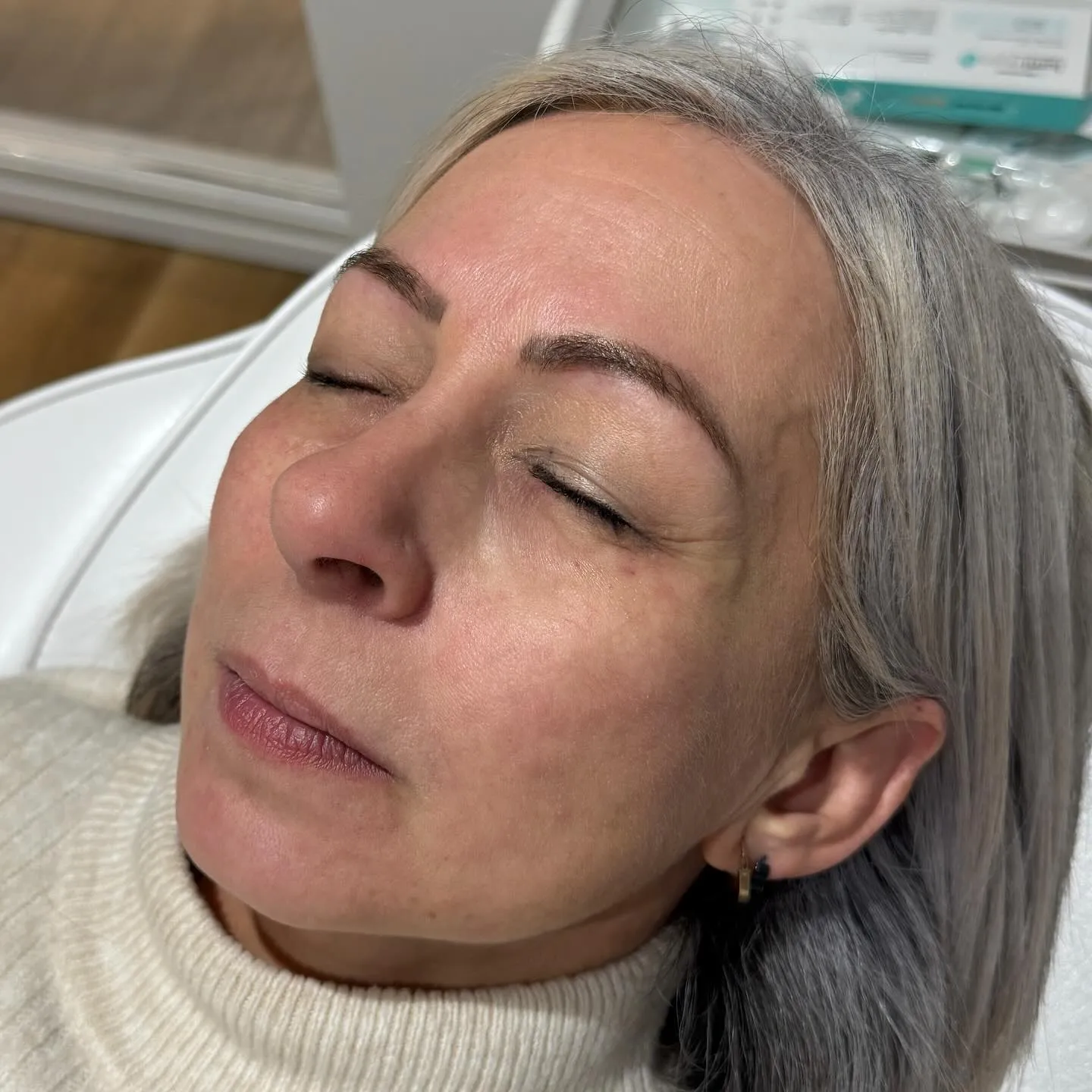Under-eye filler rested refreshed look before and after at Burns Salon Luton - After