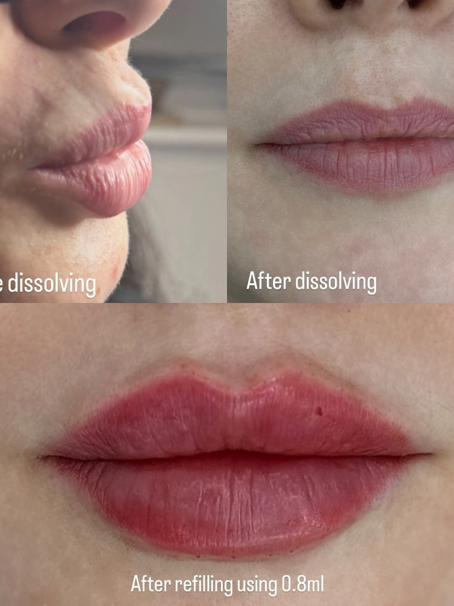 Full Reset & 0.8ml Refill - Clean baseline to plump, natural shape